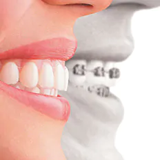 ホワイト歯科 インビザライン
