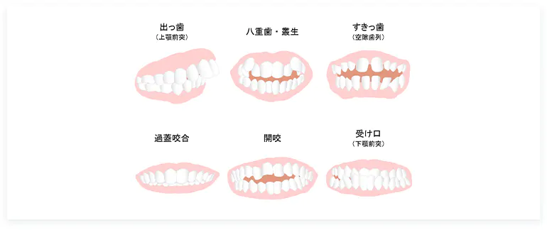様々な歯並びに対応